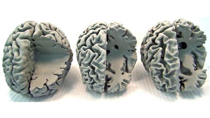 3D-printed brains reveal Alzheimer's secrets